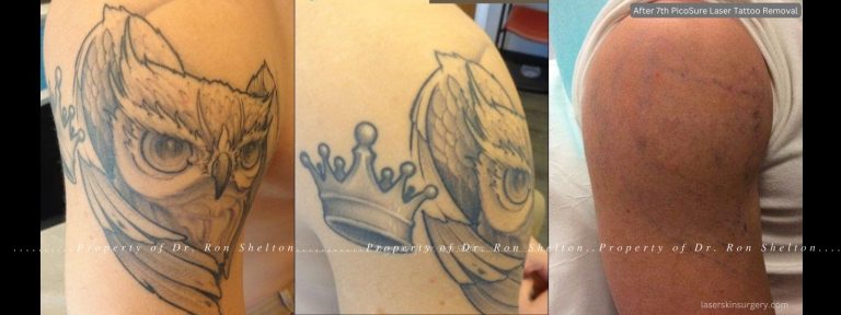 After 7th PicoSure Laser Tattoo Removal