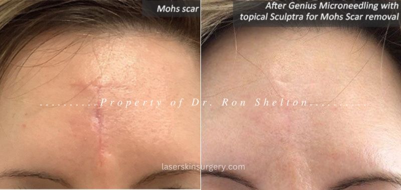 After Genius Microneedling with topical Sculptra for Mohs scar removal