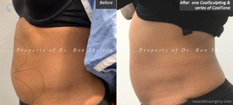 Before and After one CoolSculpting and a series of CoolTone treatments