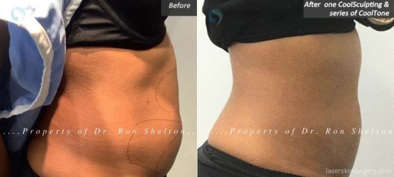 Before and After one CoolSculpting and a series of CoolTone treatments