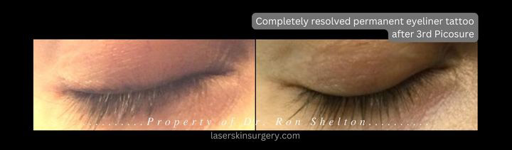 Completely resolved permanent eyeliner tattoo after 3 Picosure treatments