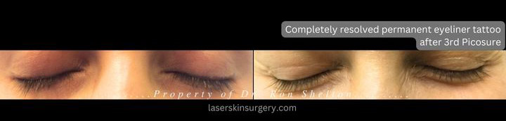 Completely resolved permanent eyeliner tattoo after 3 Picosure treatments