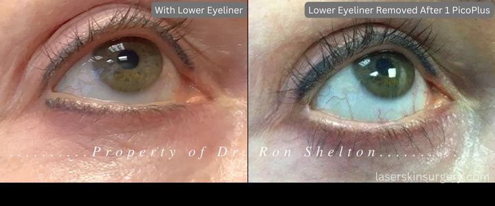Lower Eyeliner Removed After 1 PicoPlus