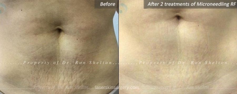 Microneedling with RF for stretch marks on tummy