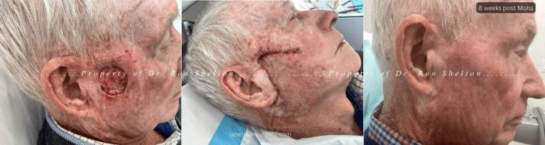 Mohs surgery on the left cheek