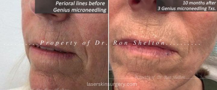 Softening of perioral lines 10 months after 3 Genius microneedling Treatments-frontal view