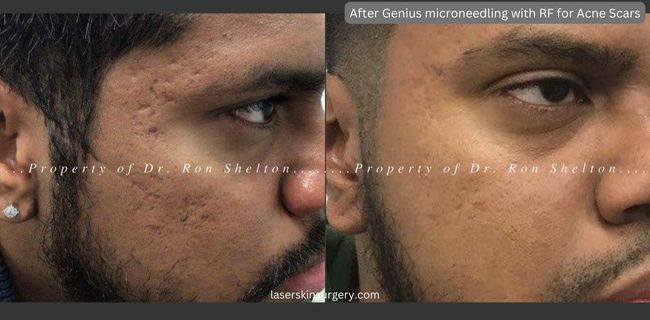 Patient completed one series of 3 Genius microneedling with RF treatments and topical Sculptra for acne scarring. He knows he can obtain more improvement from more treatments but is happy with what he received at this time