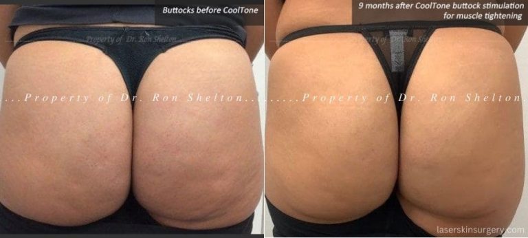 9 months post series of CoolTone Buttock Muscle Stimulation for muscle tightening. In this case we see good cellulite improvement which was not expected