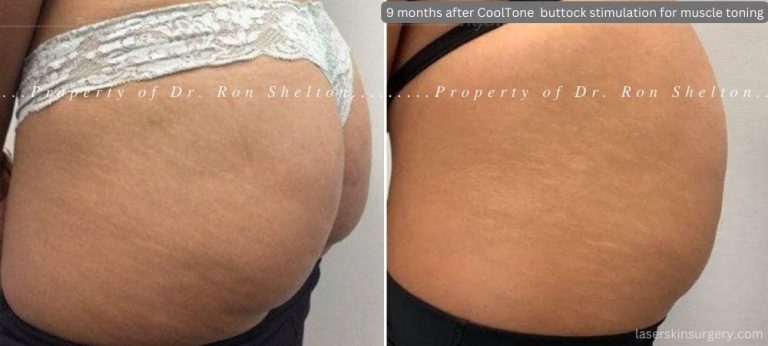 9 months post series of CoolTone Buttock Muscle Stimulation for muscle tightening. In this case we see good cellulite improvement which was not expected!