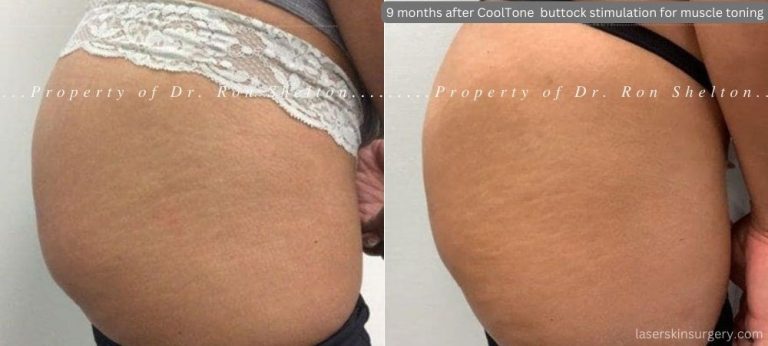 9 months post series of CoolTone NYC Buttock Muscle Stimulation for muscle tightening. In this case we see good cellulite improvement which was not expected!