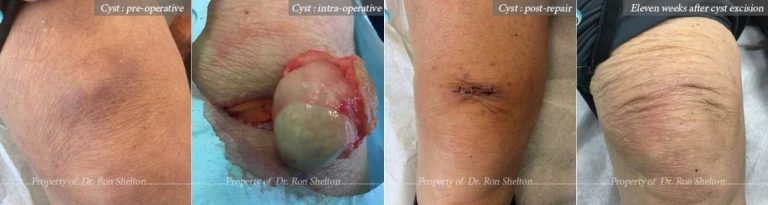 11 weeks after excision of Preoperative and Intraoperative cyst