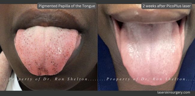 2 weeks after PicoPlus laser treatment for Pigmented Papillae of the tongue