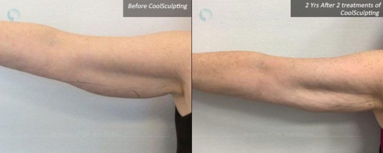 2 years after 2 treatments of CoolSculpting