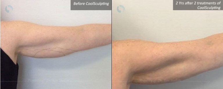 2 years after 2 treatments of CoolSculpting