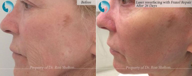 26 Days after Laser resurfacing with Fraxel Repair, CO2