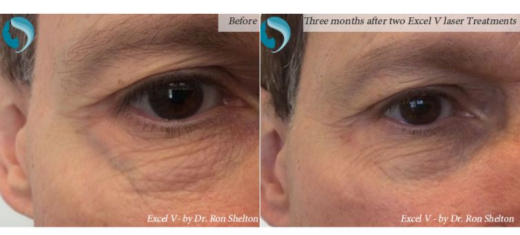 Excel V can treat the bulging veins of the periorbital area. Above patient had 2 treatments, and the photo is 3 months after the second.