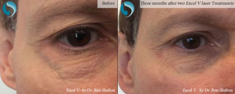 Excel V can treat the bulging veins of the periorbital area. Above patient had 2 treatments, and the above photo is 3 months after the second.
