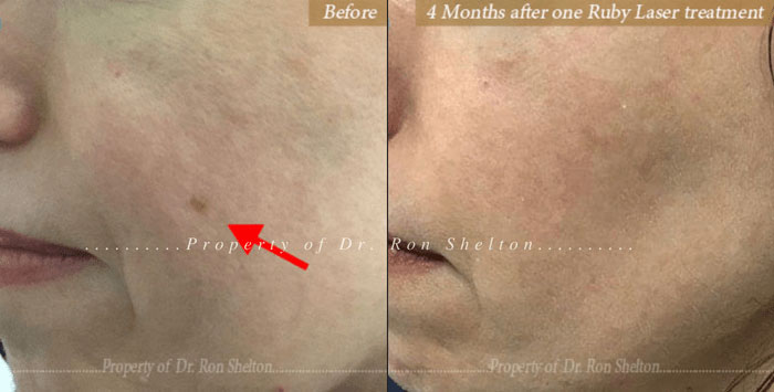 Before and 4 months after 1 Ruby laser treatment