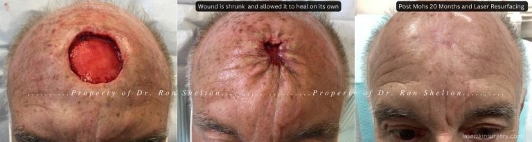 Rather than undergoing a very large flap or skin graft Dr. Shelton shrunk the wound and allowed it to heal on its own. With the help of laser resurfacing the scar is now very acceptable.