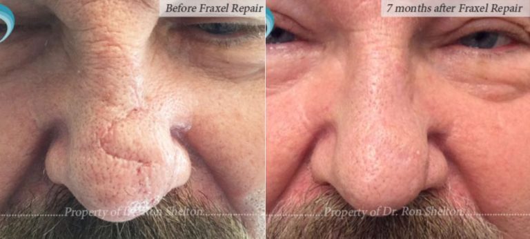 7 months after Fractional Repair (CO2) laser resurfacing of Mohs scar