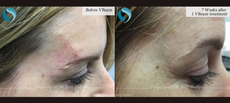 7 Weeks after 1 VBeam Treatment