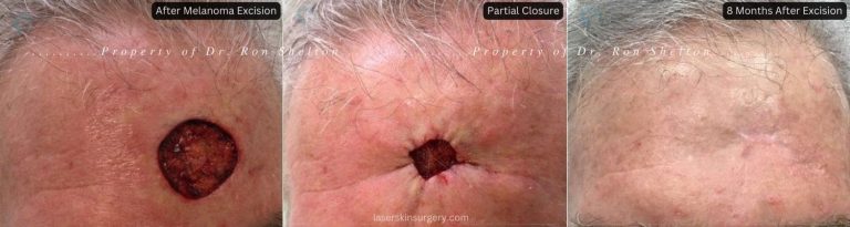 After excision of melanoma and partial purse string closure with continued healing and wound care.
