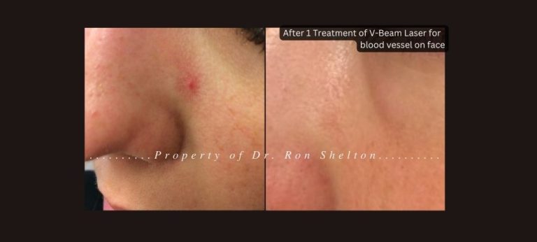 After 1 Treatment of VBeam Laser for blood vessel on face