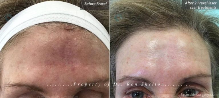 After 2 Fraxel Laser scar treatments