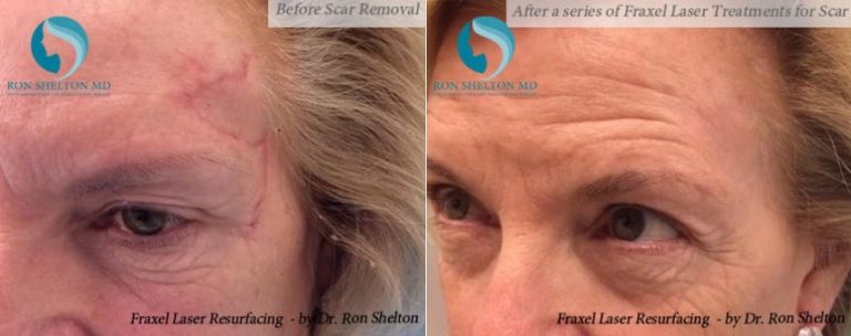 After a series of Fraxel Laser Treatments for scar removal