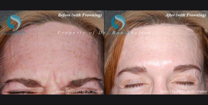 Before and after Botox for wrinkles