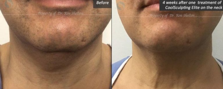 4 weeks after one treatment of CoolSculpting Elite on the neck