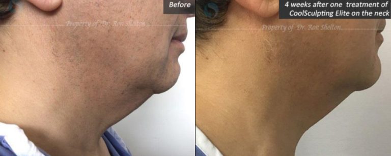 4 weeks after one treatment of CoolSculpting Elite on the neck