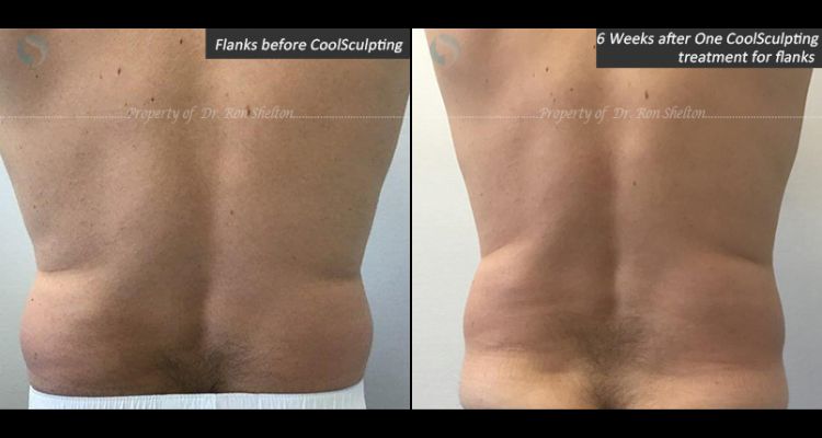 6 Weeks after one CoolSculpting treatment for flanks