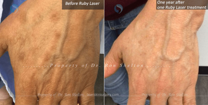 Before and One year after one Ruby Laser treatment