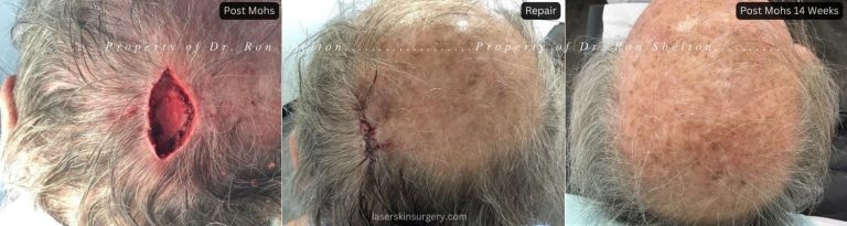 Post Mohs surgery on the scalp and after 14 weeks