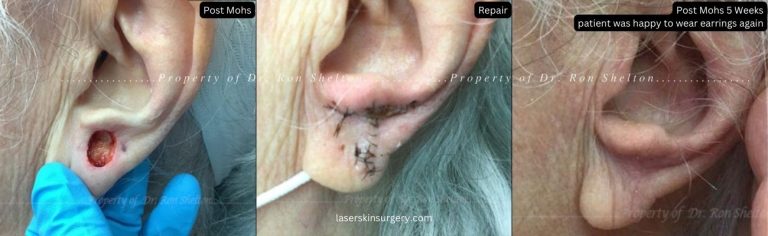 Post Mohs 5 Weeks patient was happy to wear earrings again