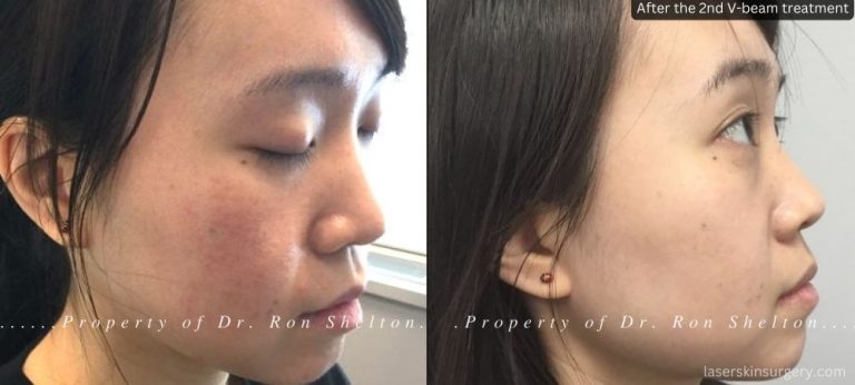 Rosacea treated with Vbeam - One month after the 2nd treatment