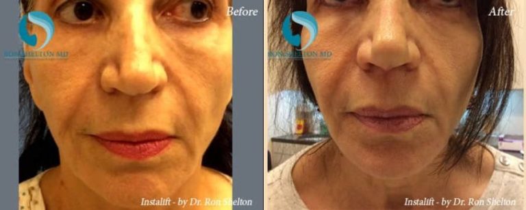 After Silhouette InstaLift Suture lift for Cheek Augmentation in NYC