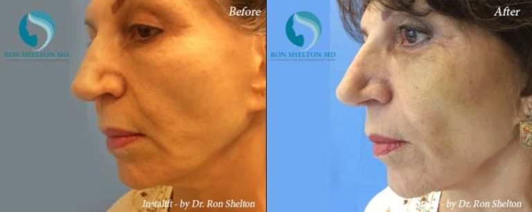 After Silhouette InstaLift NYC Suture lift for Cheek Augmentation