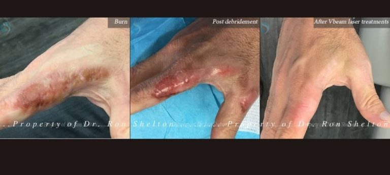V-Beam laser treatments for burn scar caused by hot oil burn in the kitchen