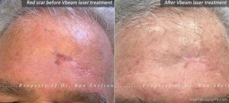 Vbeam laser treatment for red scars