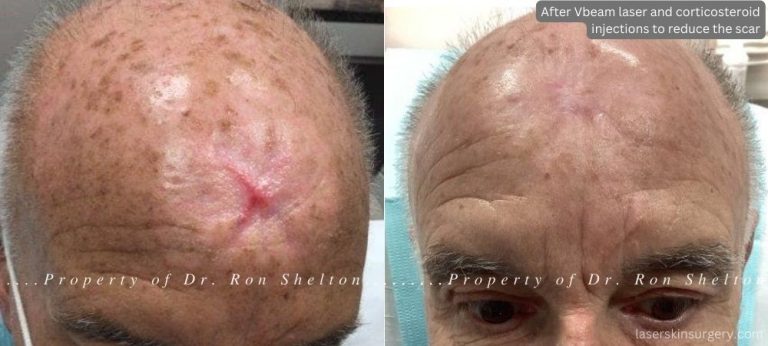 Monthly Vbeam lasers to reduce the hypertrophic red scar from post mohs wound and occasional corticosteroid injections to flatten the elevated scar and puckered surrounding skin.