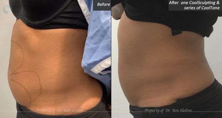 One Coolsculpting and a series of CoolTone treatments