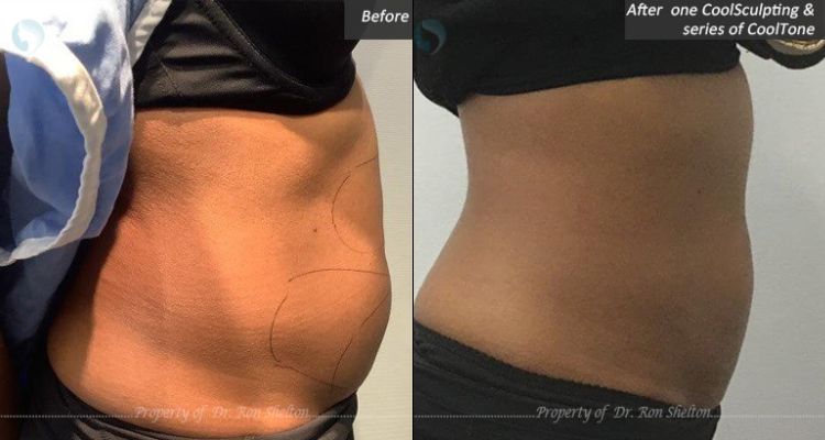 One Coolsculpting and a series of CoolTone treatments