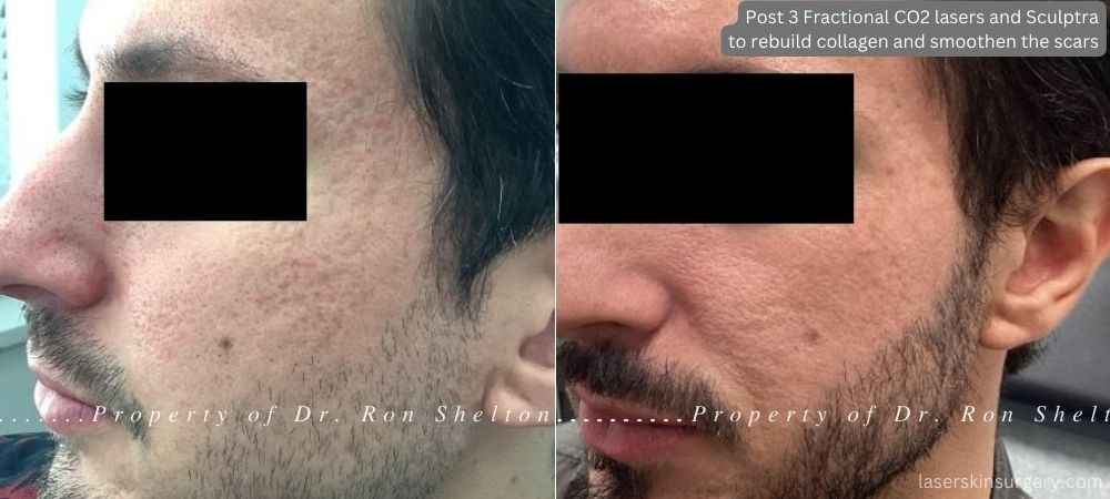 3 fractional carbon dioxide laser treatments on top of which Sculptra was applied to help rebuild collagen and smoothen the scars. The treatments were spaced 4 and then 8 months apart. The last series were taken 2 months after the last treatment.