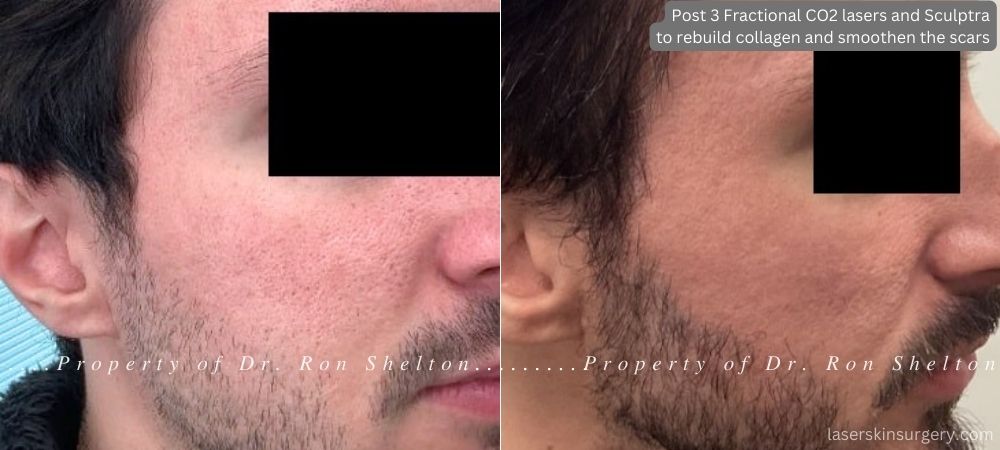 3 fractional carbon dioxide laser treatments on top of which Sculptra was applied to help rebuild collagen and smoothen the scars. The treatments were spaced 4 and then 8 months apart. The last series were taken 2 months after the last treatment.