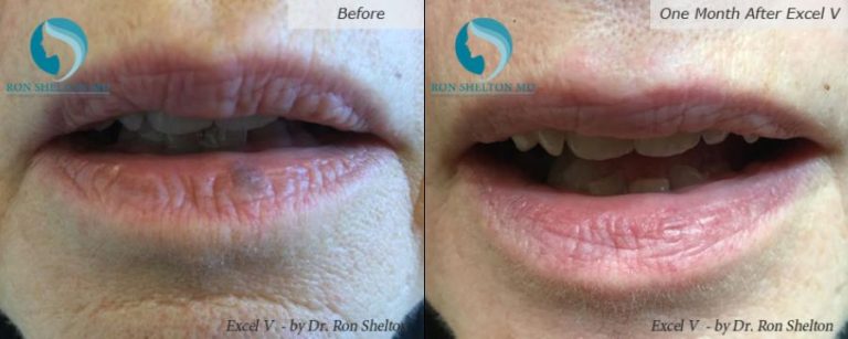 Above patient has a common venous lake, a blood vessel pooling of venous blood that's benign in their lower lip. It failed treatment with the Vbeam laser and needed a deeper laser, which we have, called the Excel V laser. This result is after one treatment 1000% resolution, no scarring