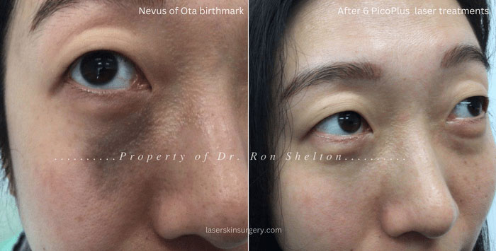 Nevus of Ota birthmark was initially treated with two ruby lasers and no improvement. After 6th and last PicoPlus laser the Nevus of Ota birthmark is close to 100% eradicated