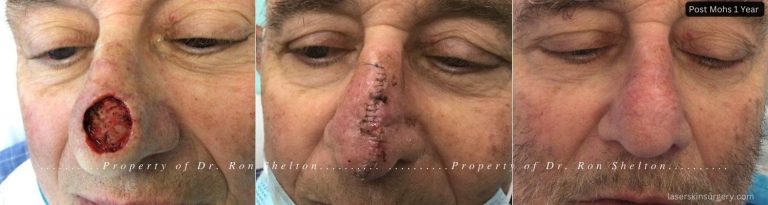 Post Mohs surgery on the nose, Repair and after 1 Year