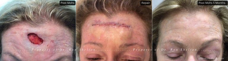 Post Mohs surgery on the forehead of a woman in NYC